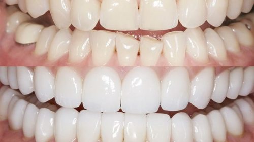 Художественная реставрация зубов и ее особенности