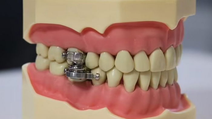 Рот на замок! Ученые создали устройство для похудения, которое крепится на зубах