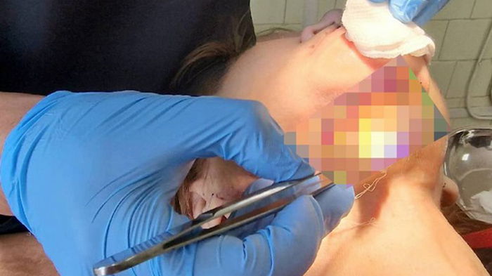 У росіянки через панічний страх перед стоматологами зігнила щелепа